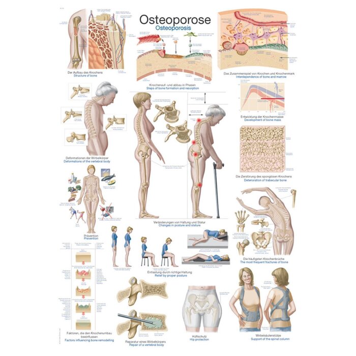 Erler-Zimmer Anatomische Lehrtafel "Osteoporose" 70 x 100 cm